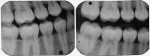 Figure 8b  Preoperative bite wing film shows proximal caries lesions (left). One year after Class II 