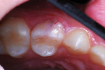 Fractured buccal surface of maxillary right primary first molar at presentation.