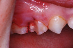 Profound anesthesia was achieved with a local infiltration, and the fractured segment was removed.