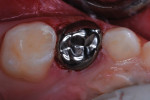 Occlusal view of the restoration immediately after crown cementation.