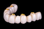 Extraoral view of an FP1 zirconia hybrid prosthesis.