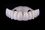 Extraoral view of PMMA temporary shell with palatal seating strap.