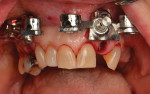 Retracted views of fixated base guides being used for surgery.