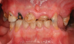 Preoperative retracted photograph of patient with severely damaged dentition.