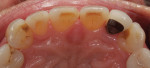 Pretreatment palatal view of the maxillary anterior teeth. Tooth No. 10 had been endodontically treated with a metal post and metal-ceramic crown.