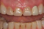 Close-up retracted facial view with the teeth apart showing chipping on tooth No. 8 as well as the discoloration of teeth Nos. 7 and 9. The preferred treatment plan was to restore teeth Nos. 6 through 11 with all-ceramic crowns.