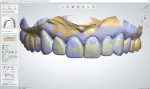 The scan of the provisional restorations was used as a guide to design the shape, form, and position of the final restorations.