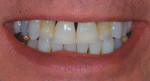 Initial examination smile photograph demonstrating visible black triangles, discrepancies in tooth color, and uneven tooth lengths.
