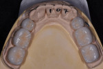 Maxillary and mandibular stone models, respectively, showing the indirect lithium disilicate restorations and the remaining stone teeth that would receive direct composite restorations.
