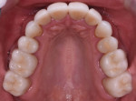 Occlusal views of the maxillary and mandibular arches following placement of the indirect restorations. Note the blend of contour and color between the appearance of the natural teeth and the indirect restorations.