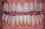 Fig 10. Five-year postoperative follow-up retracted photograph with teeth apart.