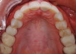 Initial examination occlusal view of the maxillary arch.