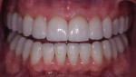 Posttreatment retracted views with the teeth in the maximum intercuspation position and apart. Note the gingival symmetry, more idealized tooth proportions, and blend of color.