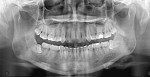 Fig 1. Preoperative OPG showing bilateral horizontally impacted mandibular third molars.