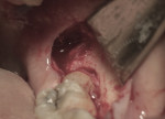 Fig 3. Full-thickness flap reflected exposing impacted mandibular third molar. Guttering of the buccal bone was performed during disimpaction of the mandibular third molar.