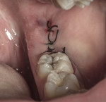 Fig 6. Suturing of the grafted site.