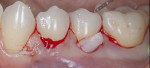Fig 4. CTG with a coronally advanced tunnel flap being placed at teeth Nos. 20–21 to obtain root coverage.