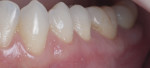Fig 5. Final result after 6 weeks of healing showing complete root coverage at teeth Nos. 20–21.
