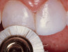 Figure 6  Clinical applications of RBCs for posterior restorations: occlusal caries restored with silorane-based RBC
