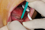 Figure 8  A 3-mm disposable dermal punch was used to remove a soft tissue plug over each pilot hole at the crest.