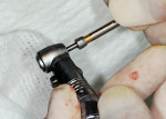 Figure 10  ERA mini-implant within the titanium sleeve being placed onto the rotary implant carrier.