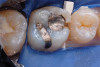 Figure 4. Screw-retained implant restoration after delivery.