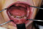 Figure 14  Five mini-implants were placed into the lower arch with good spread across the arch.