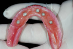 Figure 18  The finished ERA overdenture showing five Micro OV housings within the denture.