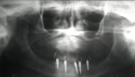 Figure 19  The final panoramic radiograph shows the placement of the five ERA mini-implants.