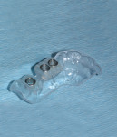 An implant surgical guide commercially fabricated from the patient’s CBCT data. The guide is seated on the adjacent teeth, and the embedded metal sleeves accommodate the drill keys from the surgical guide kit.