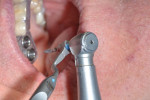 The osteotomies were performed using a series of drills in increasing diameters with corresponding keys that control their position and depth when combined and inserted into the surgical guide sleeves. There is an intimate fit of the drill into the key and then of the key into the sleeve.