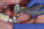The osteotomies were performed using a series of drills in increasing diameters with corresponding keys that control their position and depth when combined and inserted into the surgical guide sleeves. There is an intimate fit of the drill into the key and then of the key into the sleeve.