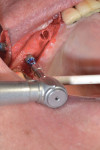 In this case, the guided implant transfer piece was not used to place the implants. The surgical guide was removed, and the implants were placed directly into their prepared osteotomies.
