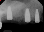 Immediate posttreatment radiograph acquired to evaluate implant placement.