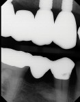 Bitewing radiographs following delivery of the final prostheses.