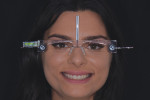 Facial reference glasses were used to align the patient’s horizontal and vertical planes.