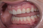 Pretreatment close-up retracted views of the patient’s smile revealed chipped teeth from a sports injury and worn maxillary teeth from a parafunctional grinding habit.