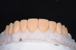 The diagnostic wax-up designed and fabricated by the dental laboratory created an ideal contour and length for the no-preparation veneers.