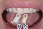 A shade tab photograph provided the laboratory with the patient’s natural tooth color to help achieve the desired bleach shade of the final restorations.