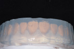 A clear silicone matrix was fabricated in-office to facilitate an injection molding technique for the temporary restorations.