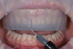 A bleach shade composite was injected into the seated matrix to create the temporary restorations.