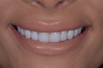 Posttreatment close-up smile, left lateral, and right lateral photographs of the final prepless lithium disilicate veneers.