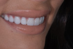 Posttreatment close-up smile, left lateral, and right lateral photographs of the final prepless lithium disilicate veneers.
