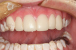 Figure 10  An example of no-preparation veneers that demonstrates the concern that many dentists have with the no-preparation concept.