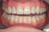 Figure 5  Locator abutments placed on implants can also be used for an implant-assisted prosthesis.