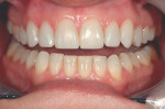 Figure 12  Prototype veneers are placed to allow the patient to visualize the esthetic potential and for the dentist to communicate with the laboratory.