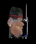 Fig 12. Integration of the facial and intraoral scans into CAD software, yielding high precision. Both the front of the patient and the intraoral situation will be visible on the screen, allowing the virtual articulator to be used and the prosthetic piece to demonstrate function.