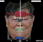 Fig 14. The technician can start to design the new smile using the horizontal lines as reference.