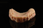 Fig 19. Radiographic markers were added to the maxillary denture for CBCT scanning.