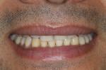 Fig 1. Smile showing less than 75% of the anterior teeth and no gingival display.